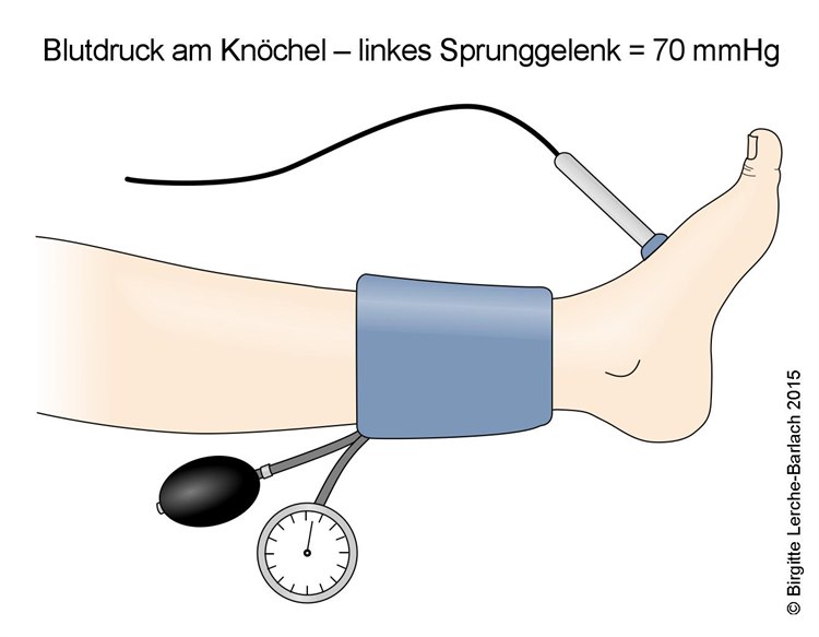 130-blutdruck-am-knochel.jpg 130-blutdruck-am-knochel.jpg