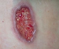 Das klassische Pyoderma gangraenosum tritt in Form eines tiefen Ulkus in Erscheinung, das scharf umschrieben ist und in der Regel einen violetten oder blauen Rand aufweist. Das klassische Pyoderma gangraenosum tritt in Form eines tiefen Ulkus in Erscheinung, das scharf umschrieben ist und in der Regel einen violetten oder blauen Rand aufweist.