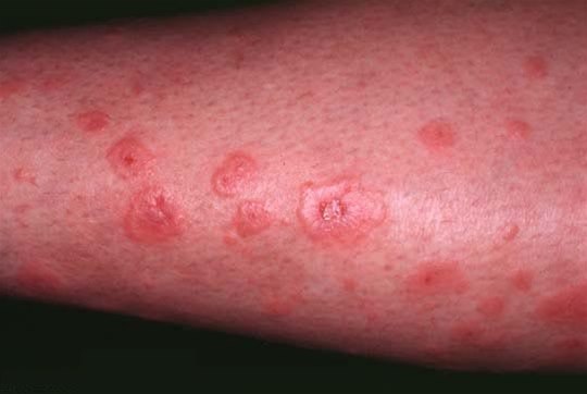 Erythema multiforme Erythema multiforme