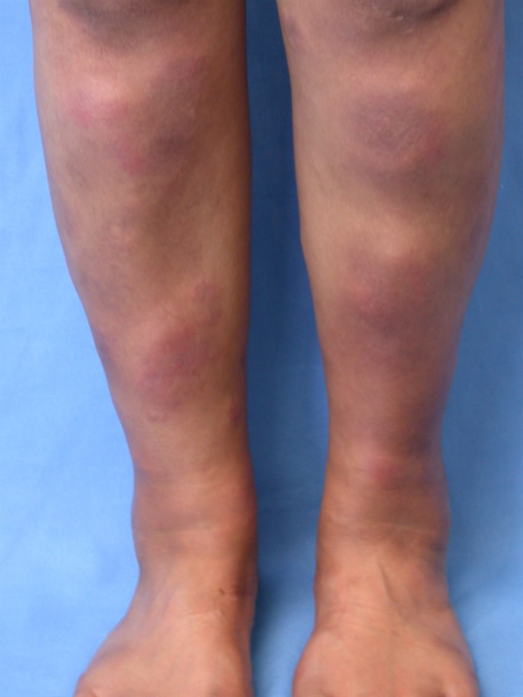 Erythema nodosum Erythema nodosum