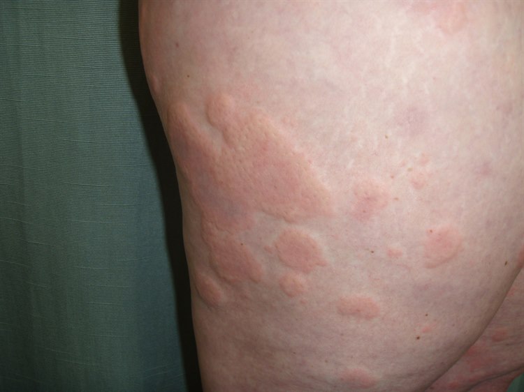 Typische Quaddeln bei Urtikaria Typische Quaddeln bei Urtikaria