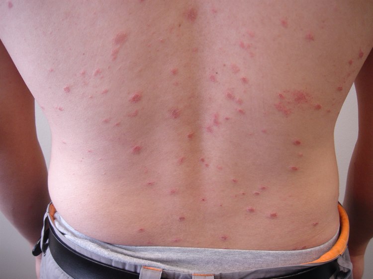 Pityriasis rosea, späterer Ausschlag Pityriasis rosea. Am Körperstamm verläuft der längste Durchmesser der Ausschläge parallel zu den Rippen in Längsrichtung der Haut, was meist aus ein wenig Abstand einfach zu sehen ist.