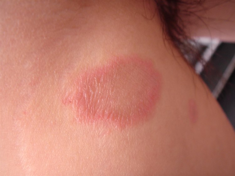 Primärmedaillon bei Pityriasis rosea Primärmedaillon bei Pityriasis rosea. Tritt vor dem allgemeinen Hautausschlag auf und ist oft größer und stärker ausgeprägt als die anderen Effloreszenzen.