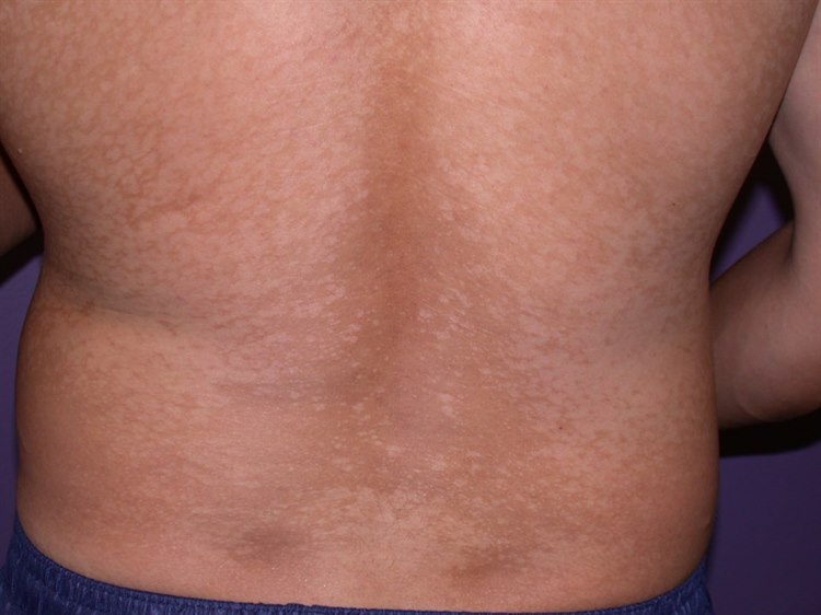 Pityriasis versicolor