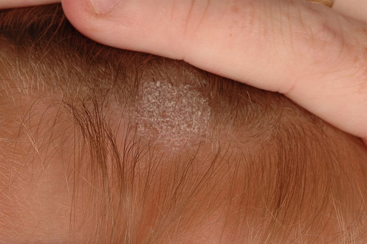 Tinea capitis Tinea capitis