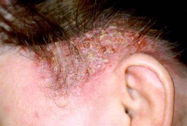 Tinea capitis profunda Tinea capitis (Tinea capitis profunda)