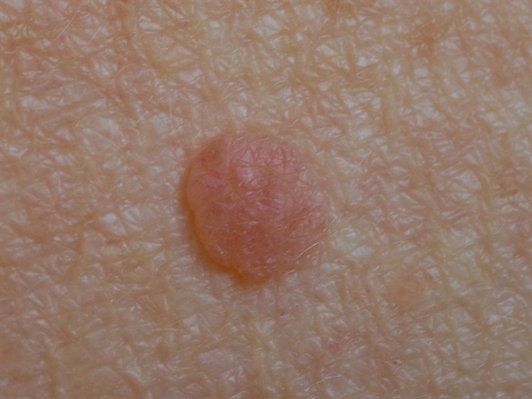 Nävus, dermal (bei älteren Menschen) Nävus, dermal (bei älteren Menschen)