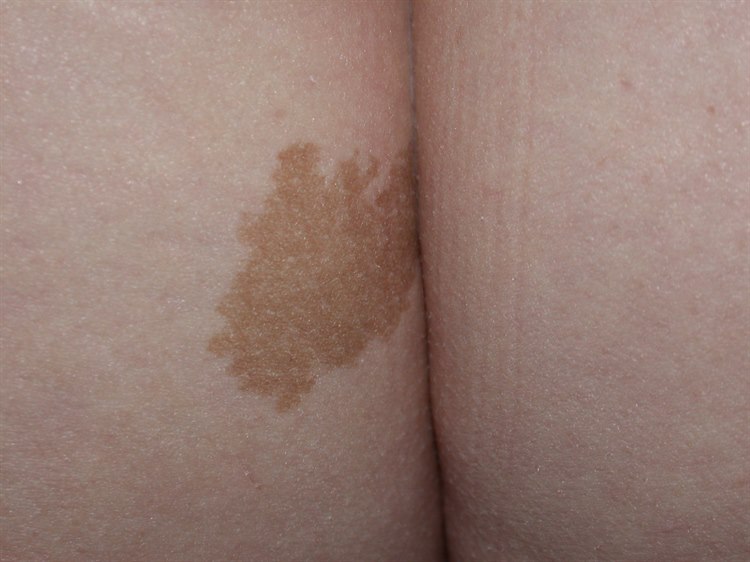 Neurofibromatose, Café-au-lait-Fleck Neurofibromatose, Café-au-lait-Fleck