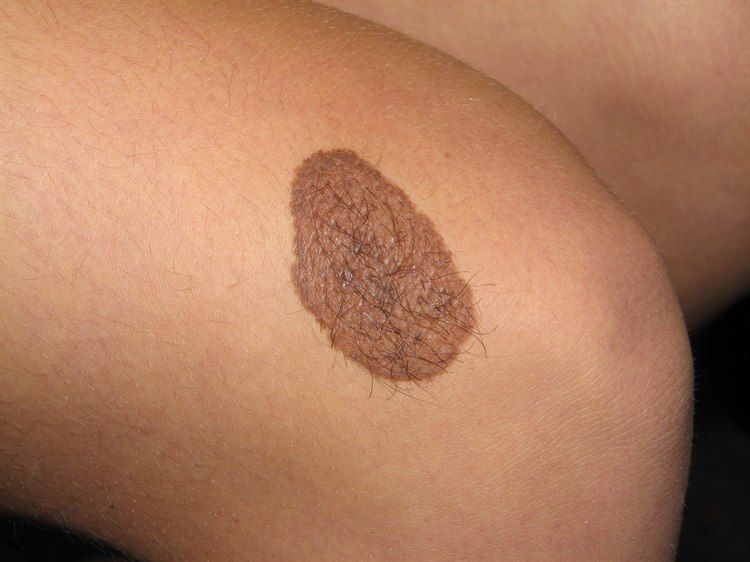 Nävus, angeboren Nävus, angeboren