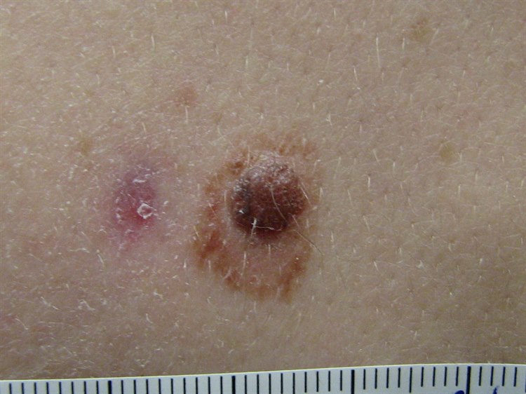 Nävus, atypisch Nävus, atypisch