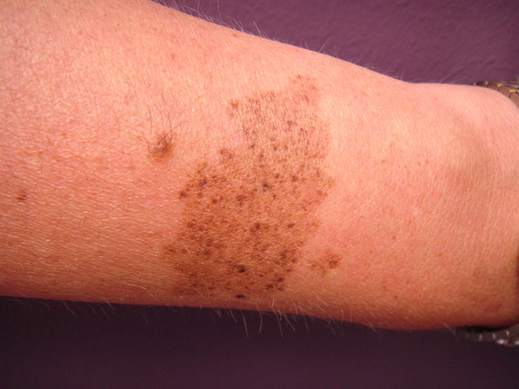 Nävus, kongenital (spileus) Nävus, kongenital (spileus)