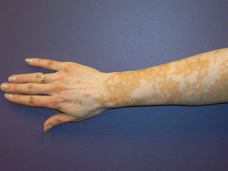 Vitiligo Vitiligo