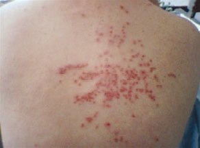 Eczema herpeticatum Ekcema herpeticatum