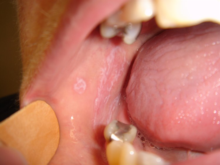 Lichen ruber im Mund Lichen ruber im Mund