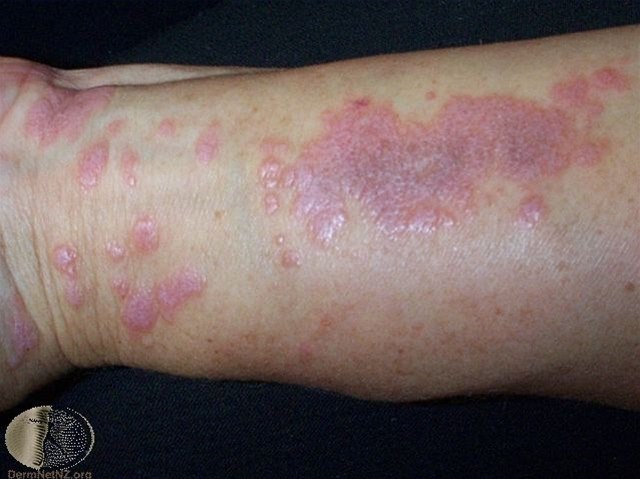 Lichen ruber Lichen ruber