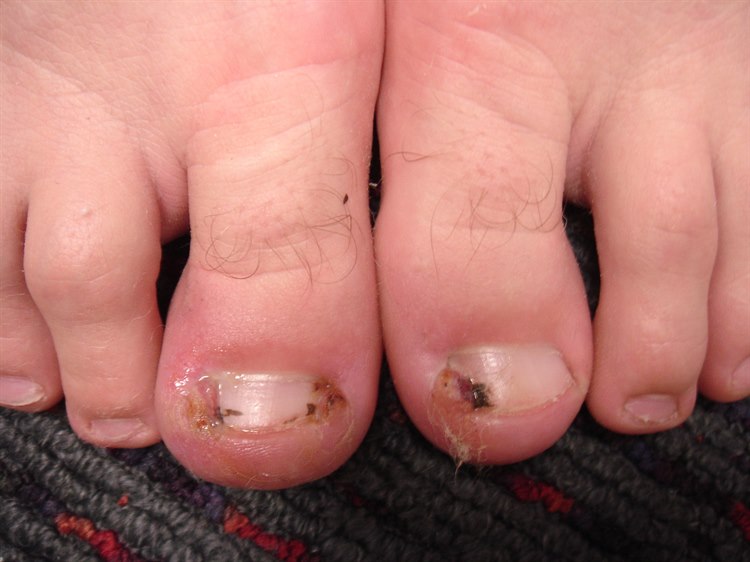 Eingewachsene Zehennägel (Unguis incarnatus) Eingewachsene Zehennägel (Unguis incarnatus)