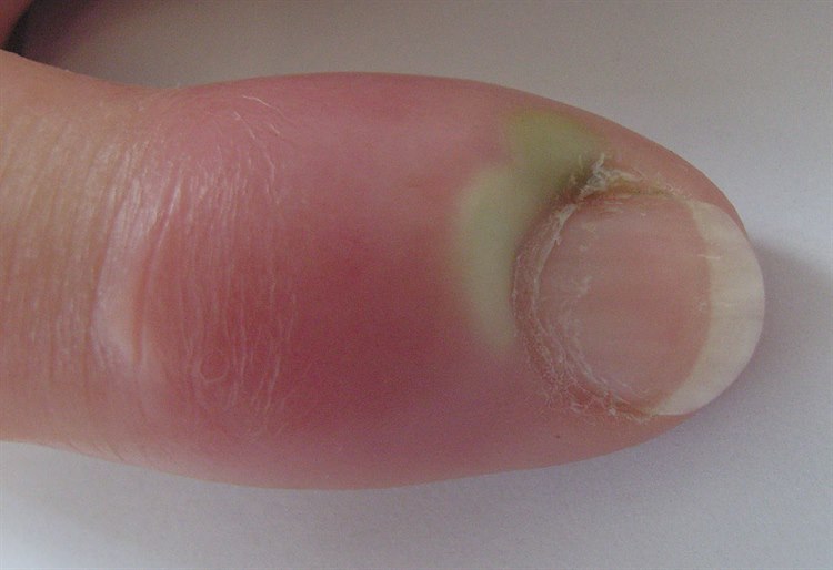 Eitrige Paronychie Panaritium (eitrige Paronychie)