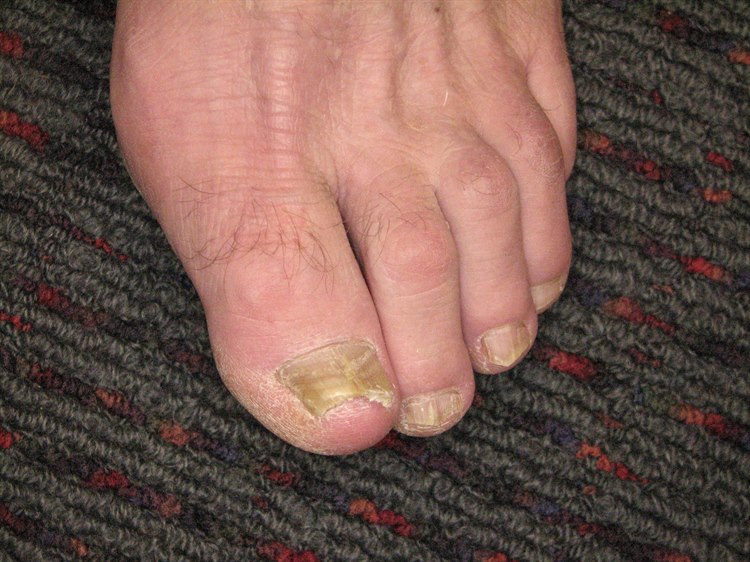 Nagelpilz Nagelpilz