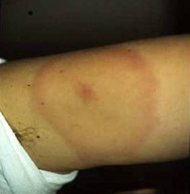 Ringförmiger Hautausschlag nach einem Zeckenstich Ringförmiger Hautausschlag nach einem Zeckenstich