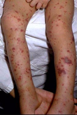 Hautblutung durch Meningokokken-Meningitis. Hautblutung durch Meningokokken-Meningitis.