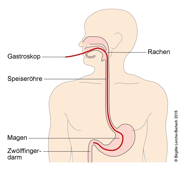 Gastroskopie Gastroskopie