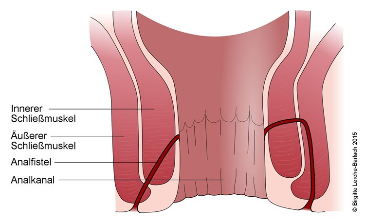 Analfistel Analfistel