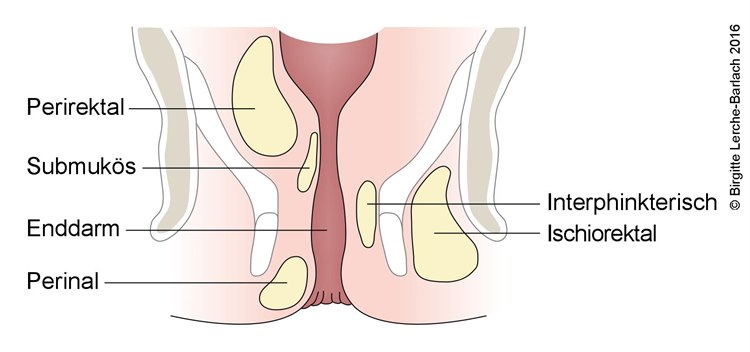Analabszess Analabszess