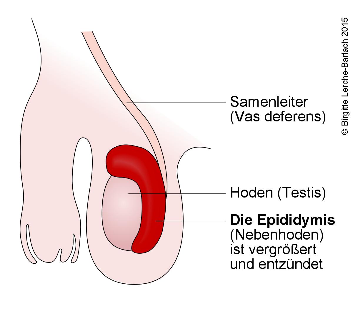 Skrotum Epididymitis.jpg Skrotum Epididymitis.jpg