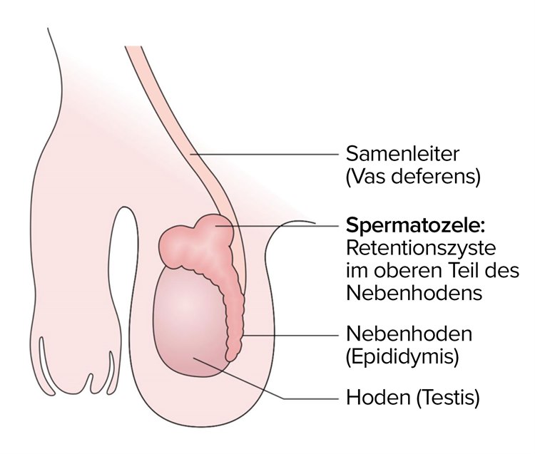 Skrotum: Spermatozele Spermatozele.jpg