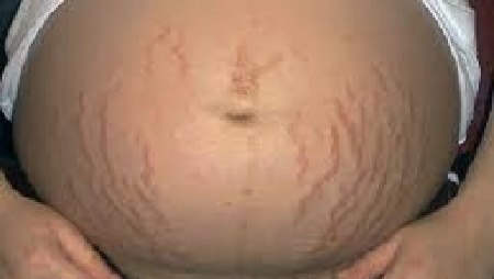 Dehnungsstreifen Dehnungsstreifen