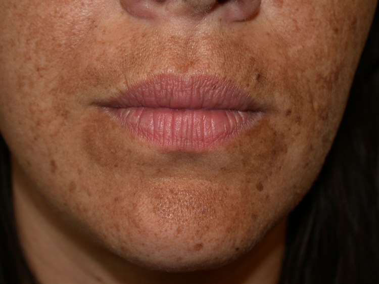 Melasma Melasma