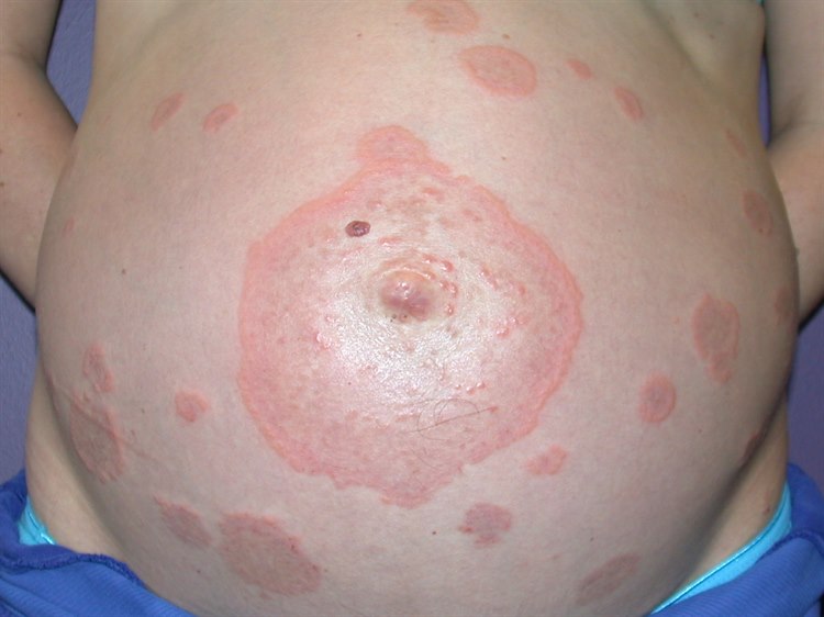 Schwangerschafts-Pemphigoid. Die Bullae treten häufig zunächst periumbilikal auf, später können erythematöse Papeln, Plaques, Bläschen und große Bullae hinzukommen. Schwangerschafts-Pemphigoid. Die Bullae treten häufig zunächst periumbilikal auf, später können erythematöse Papeln, Plaques, Bläschen und große Bullae hinzukommen.