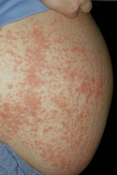 Schwangerschaftsdermatose PUPP