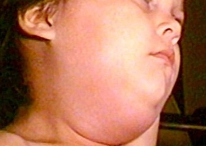 Mumps Mumps-1.0.jpg