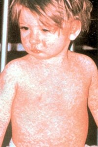 Masern, typischer Ausschlag 2064-2-meslinger.jpg