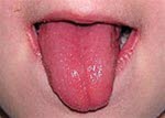 Himbeerzunge bei Scharlach Scharlach, Himbeerzunge.jpg