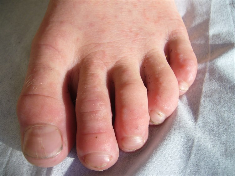 Hand-Fuß-Mund-Krankheit Bei ca. 1/3 der Patienten mit der Hand-Fuß-Mund-Krankheit bilden sich auch an den Füßen und in der Gesäßgegend Ausschläge/Vesikel. Die Blasen verschwinden innerhalb von 1–2 Wochen.