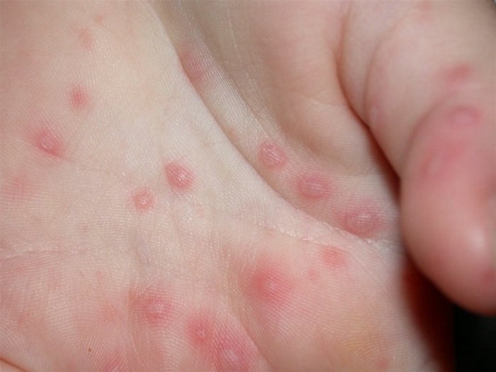 Hand-Fuß-Mund-Krankheit Die Hand-Fuß-Mund-Krankheit ist hochansteckend und kann zu kleineren Epidemien führen. Die Erkrankung kommt vor allem bei Kindern unter 10 Jahren vor.