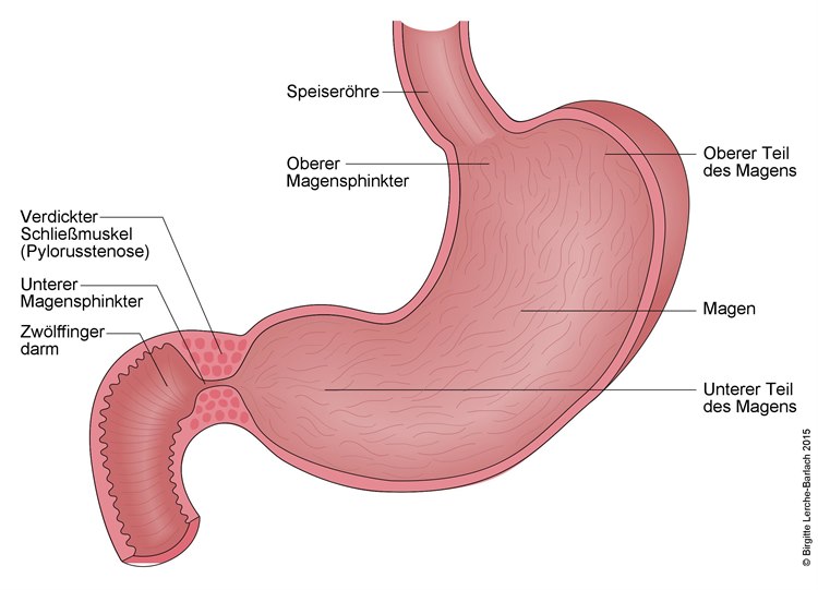 Magen mit Pylorusstenose Magen mit Pylorusstenose