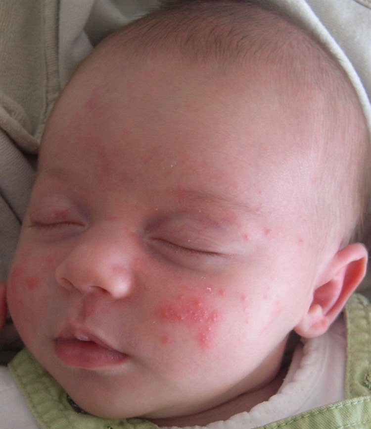 Acne neonatorum (Quelle: Wikimedia https://commons.wikimedia.org/wiki/File:Babyakne.jpg) Babyakne.jpg