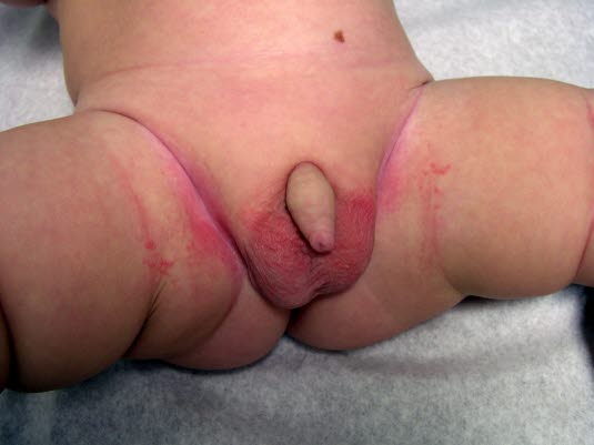 Bei der Windeldermatitis kommt es zu einem umfangreichen ekzematösen oder nässenden Hautausschlag im Windelbereich. Gräuliche Bläschen (Candida) am Rand sind möglich. Windeldermatitis mit Pilzbefall, Junge