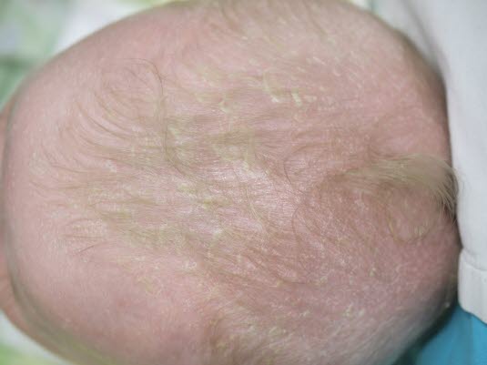 Prädilektionsstellen des seborrhoischen Ekzems beim Säugling sind die Kopfhaut, die intertriginösen Bereiche und der Windelbereich. Prädilektionsstellen des seborrhoischen Ekzems beim Säugling sind die Kopfhaut, die intertriginösen Bereiche und der Windelbereich.