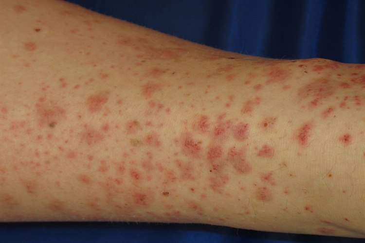 Typischer Hautausschlag bei Purpura Schönlein-Henoch Der Hautausschlag tritt meist an Extremitäten, Gesäß und perigenital auf. Die Gelenke können anschwellen.