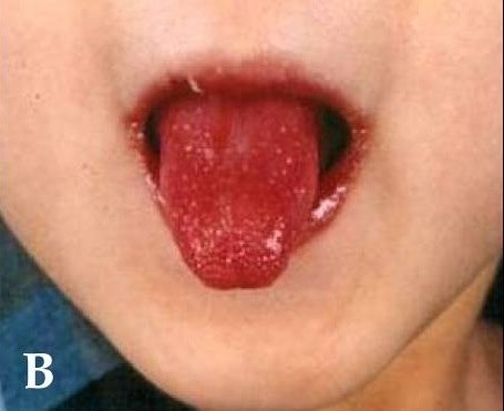 Erdbeerzunge beim Kawasaki-Syndrom Kawasaki_symptoms_B.jpg