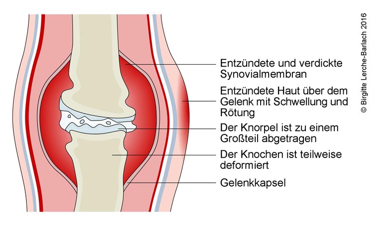 690-chronische-arthritis.jpg 690-chronische-arthritis.jpg