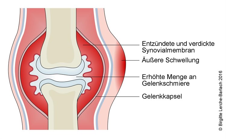 683-akute-arthritis.jpg 683-akute-arthritis.jpg