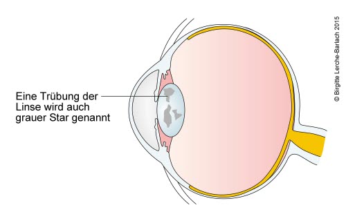 34842 Grauer Star - Längsschnitt.jpg 34842 Grauer Star - Längsschnitt.jpg