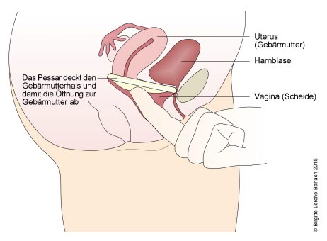 Einsetzen des Pessars 108 Pessar als Verhütungsmittel.jpg