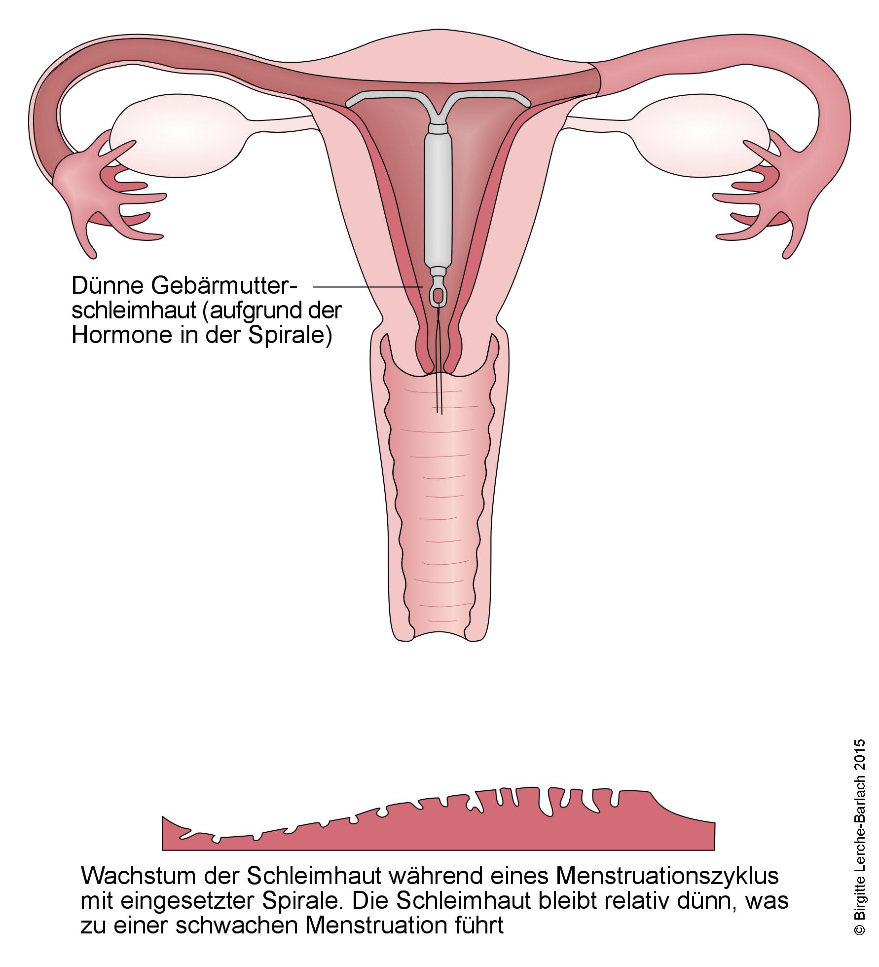 Gebärmutter mit Hormonspirale Gebaermutter mit Hormonspirale.jpg