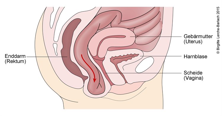 Enterozele Enterozele